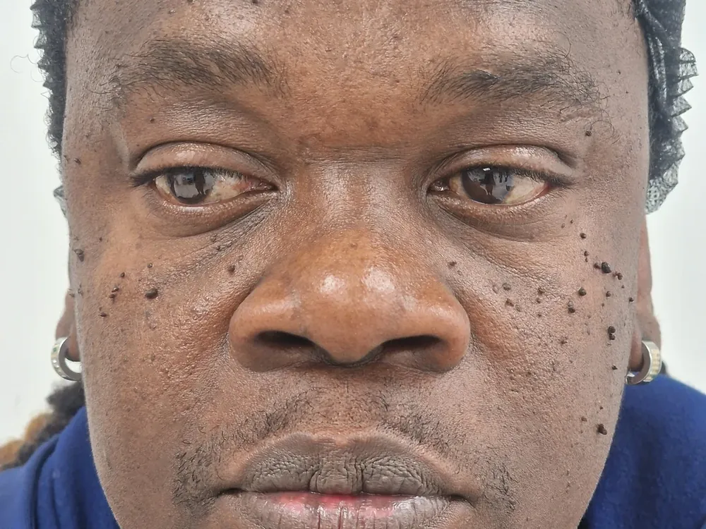 Client with DPN across the cheeks, photographed before treatment at WOB Beauty
