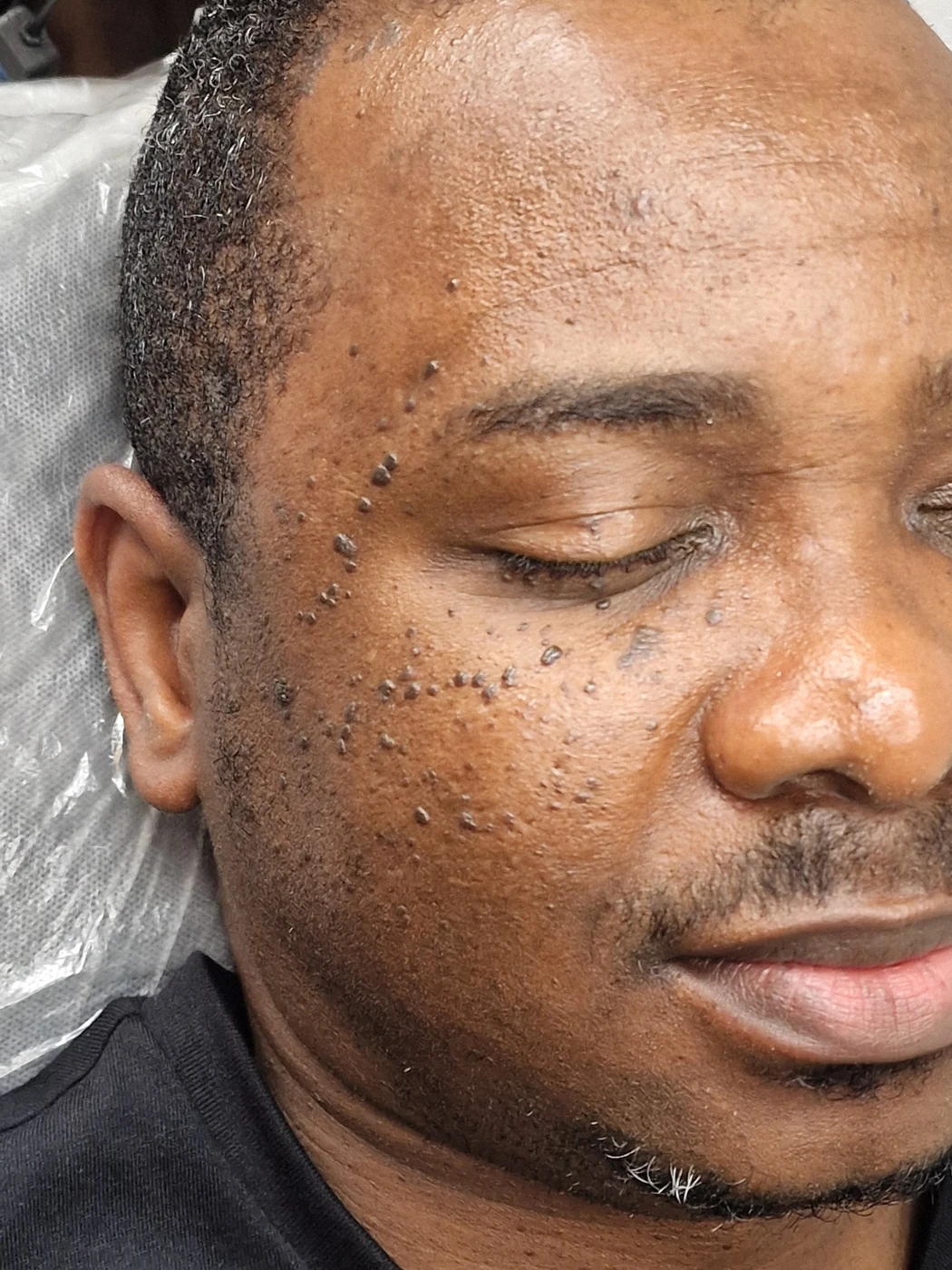 DPN removal case 02: photograph labelled before treatment