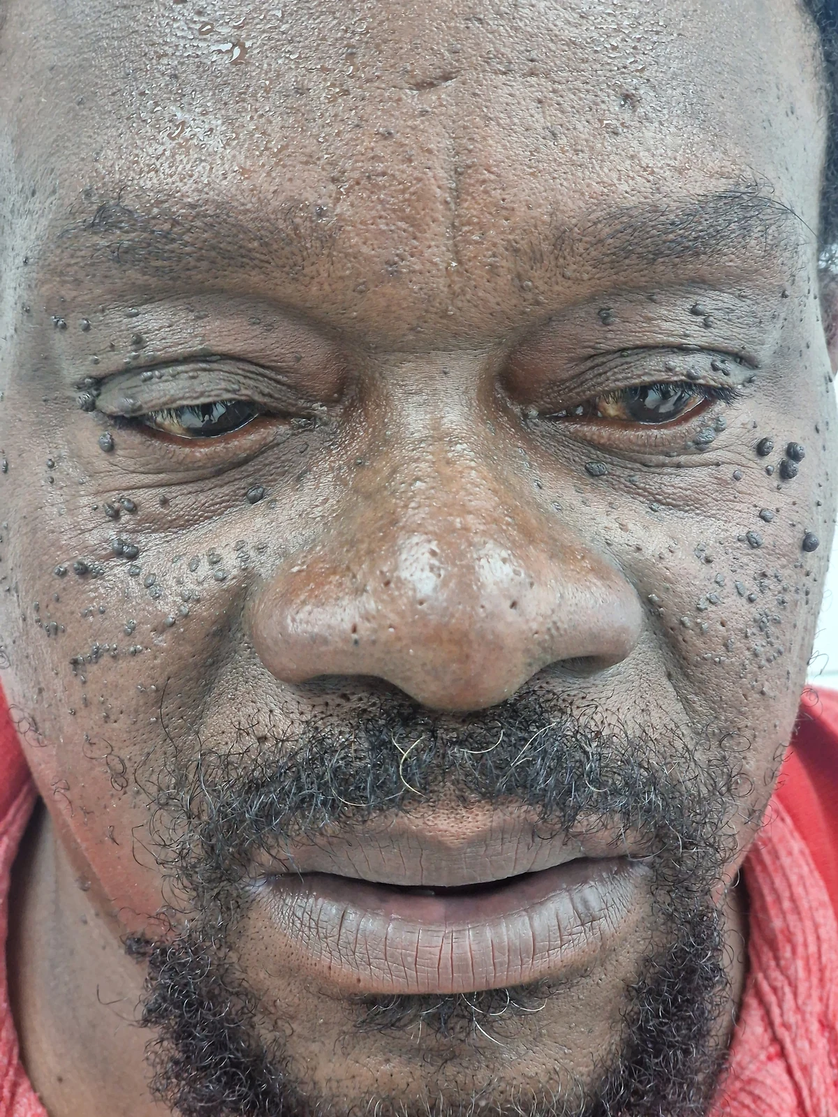 DPN removal case 06: photograph labelled before treatment