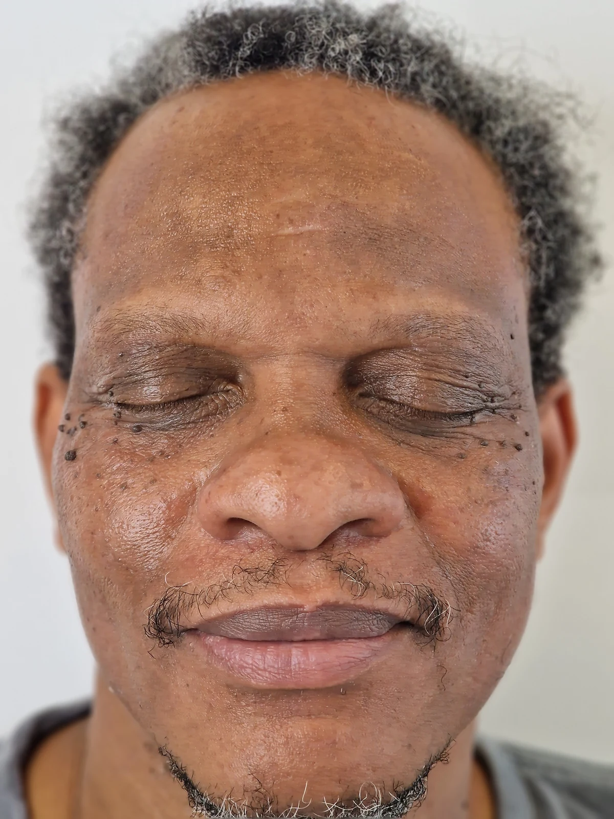 Skin tag removal case 07: photograph labelled before treatment