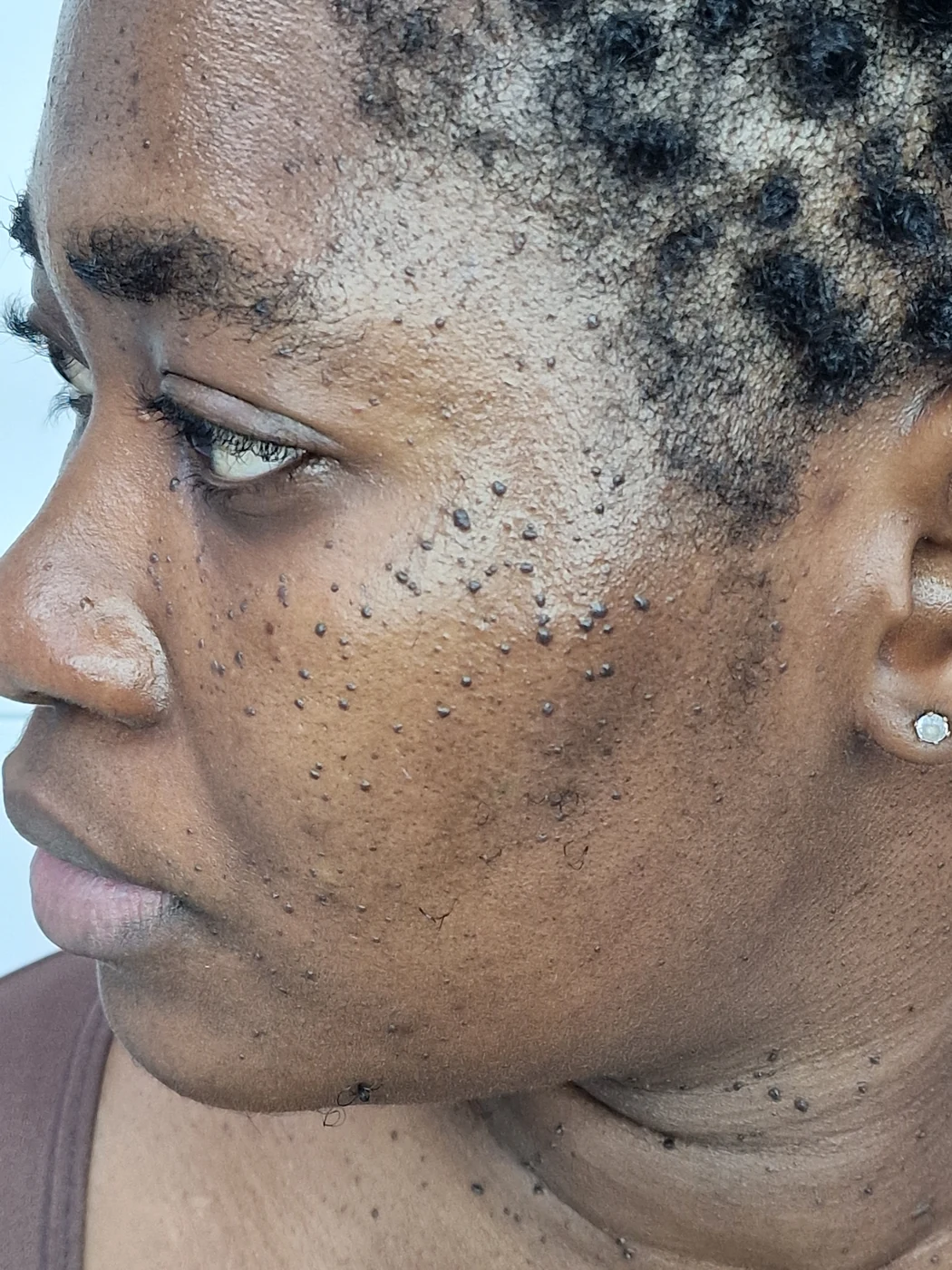 DPN removal case 03: photograph labelled before treatment