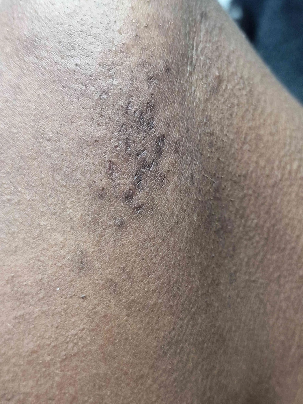 Second electrolysis progress photograph from WOB’s hair-removal page