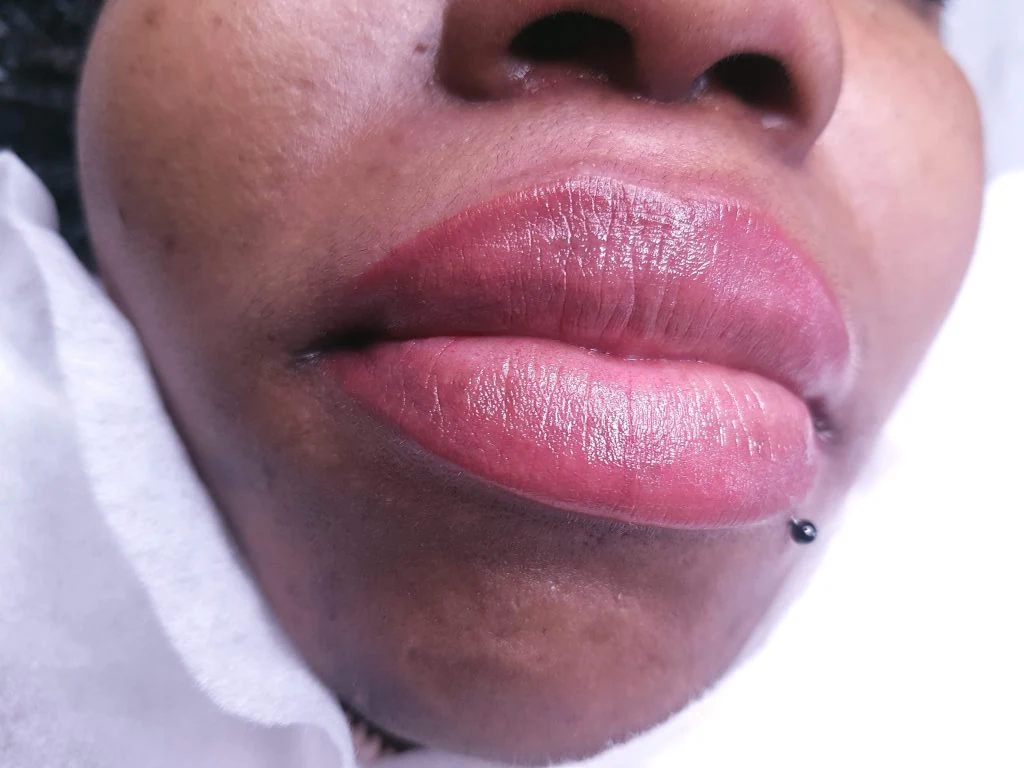 Lip neutralisation photograph from WOB’s lip treatment gallery