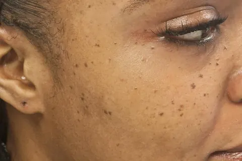 Close-up of DPN bumps on a client's cheek