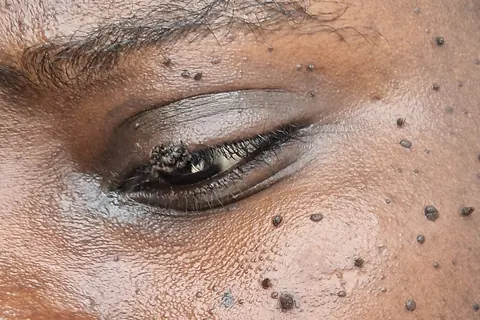 Filiform wart on a client's upper eyelid, before treatment