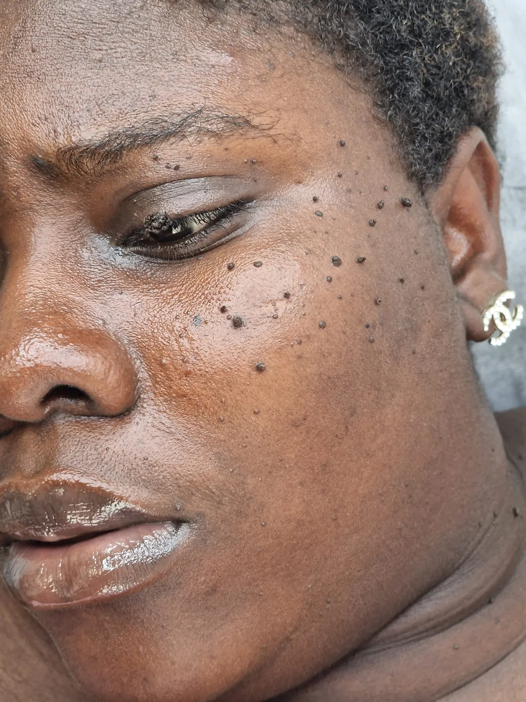 Client photographed before treatment, with a filiform wart on the upper eyelid and DPN across the cheek